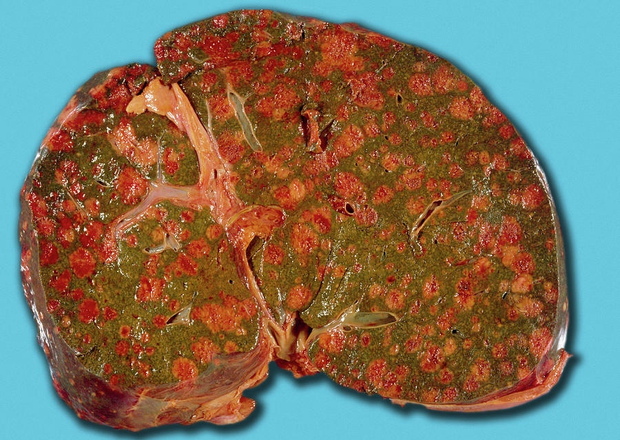 Carcinoma Photograph - Liver Cancer by Medimage/science Photo Library