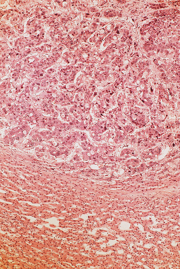 Liver Carcinoma, Lm Photograph by Michael Abbey