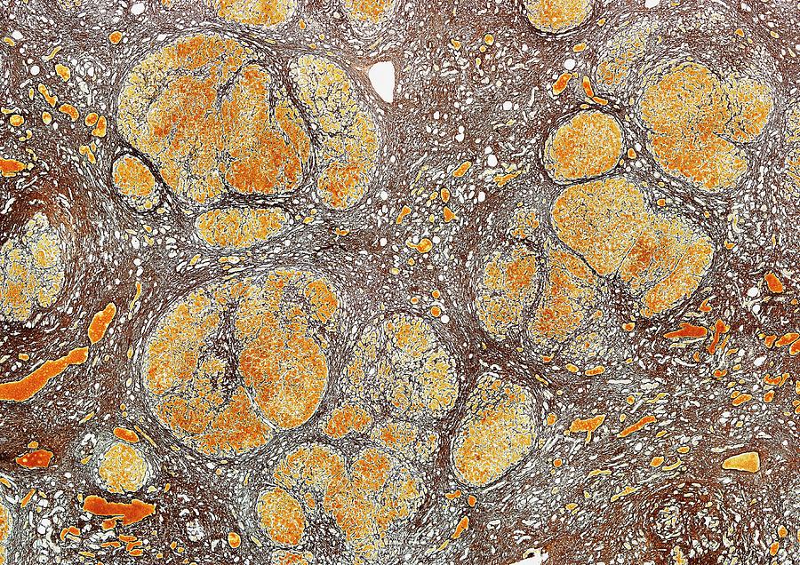Liver Photograph - Liver Cirrhosis by Microscape