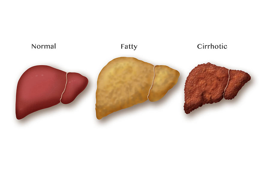 Liver Disease Progression, Illustration Photograph by Monica Schroeder ...