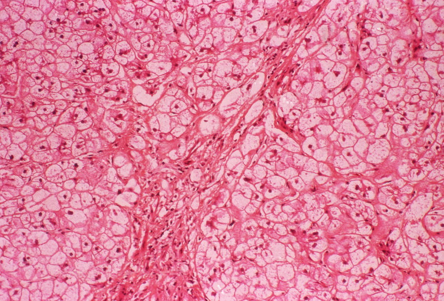Liver Glycogenosis Photograph by Cnri/science Photo Library