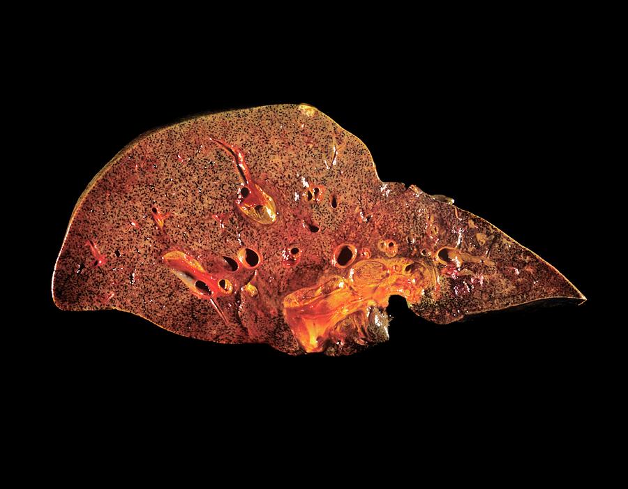 Liver In Obstructive Jaundice Photograph by Cnri/science Photo Library ...