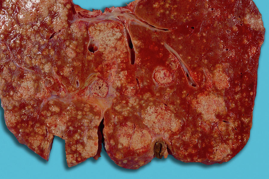 Liver Infection And Abscess Formation Photograph By Medimagescience