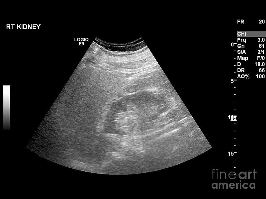 Liver Mass, Ultrasound Scan Photograph by Science Photo Library - Fine ...