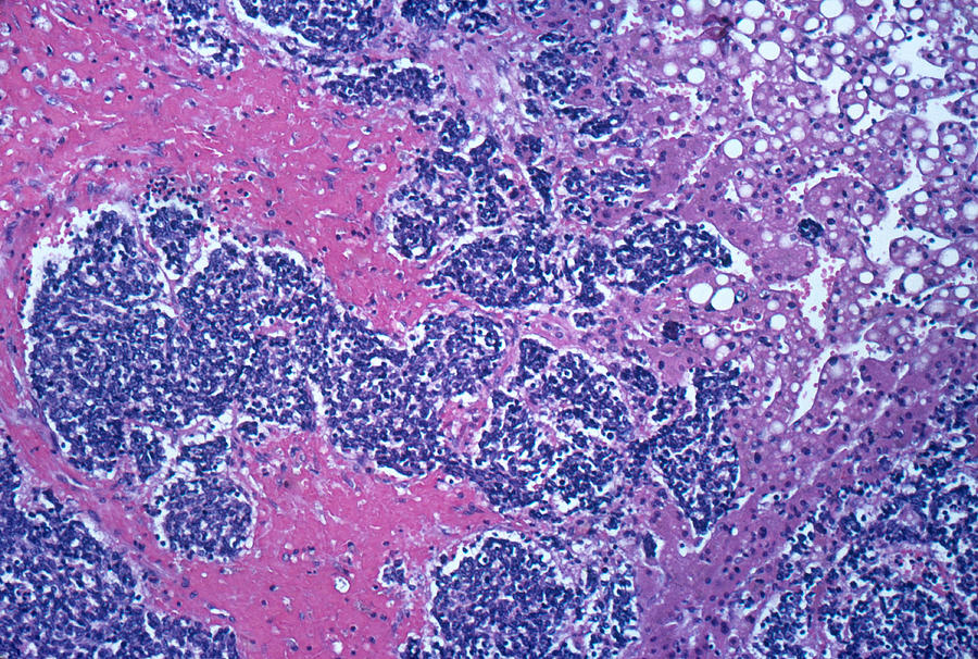 Liver With Carcinoma, Lm Photograph by Michael Abbey
