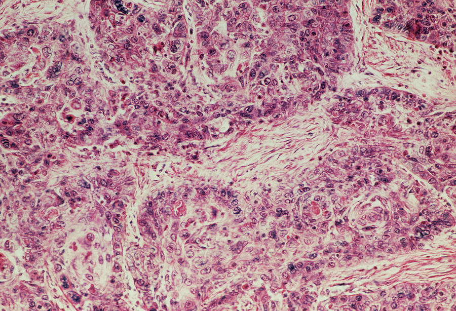 Lm Of A Section Through A Carcinoma Of The Penis Photograph by Astrid & Hanns-frieder Michler/science Photo Library
