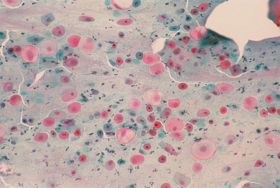 Lm Of Cervical Smear Showing Atrophic Vaginitis Photograph by Science