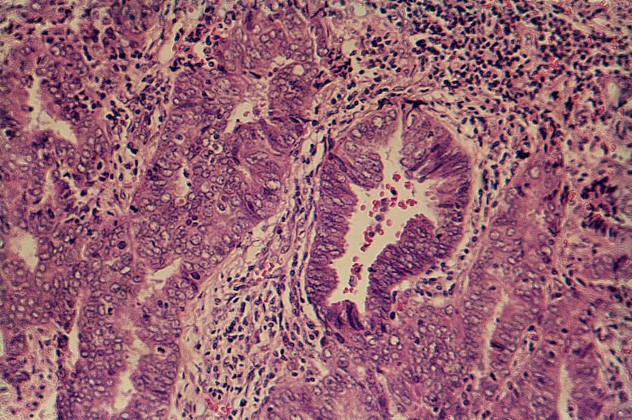 Lm Of Endometrial Carcinoma Of The Human Uterus Photograph by Science ...