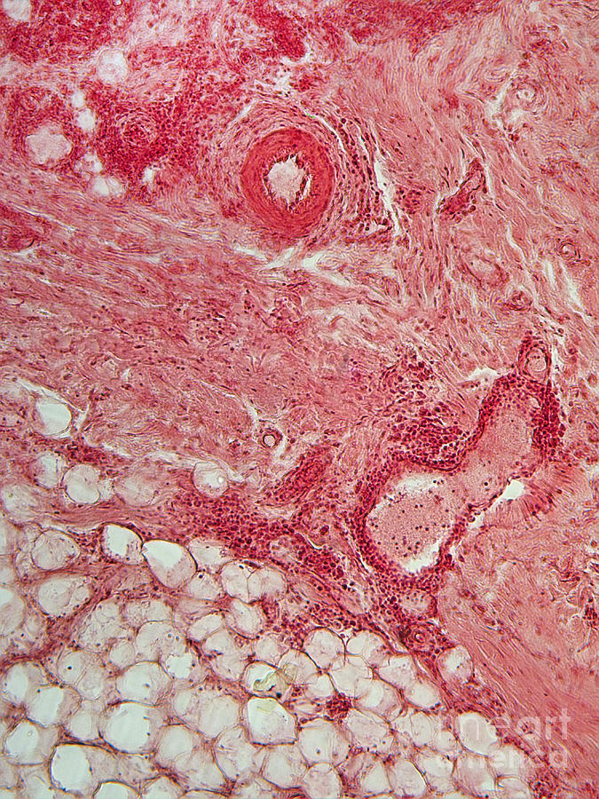 Lm Of Lupus Skin Lesion Photograph by Garry DeLong