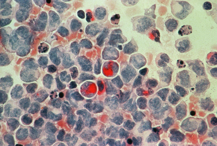 Lymphocytic Leukaemia Photograph - Lm Of Lymphocytic Leukaemia Cells by National Cancer Institute/science Photo Library