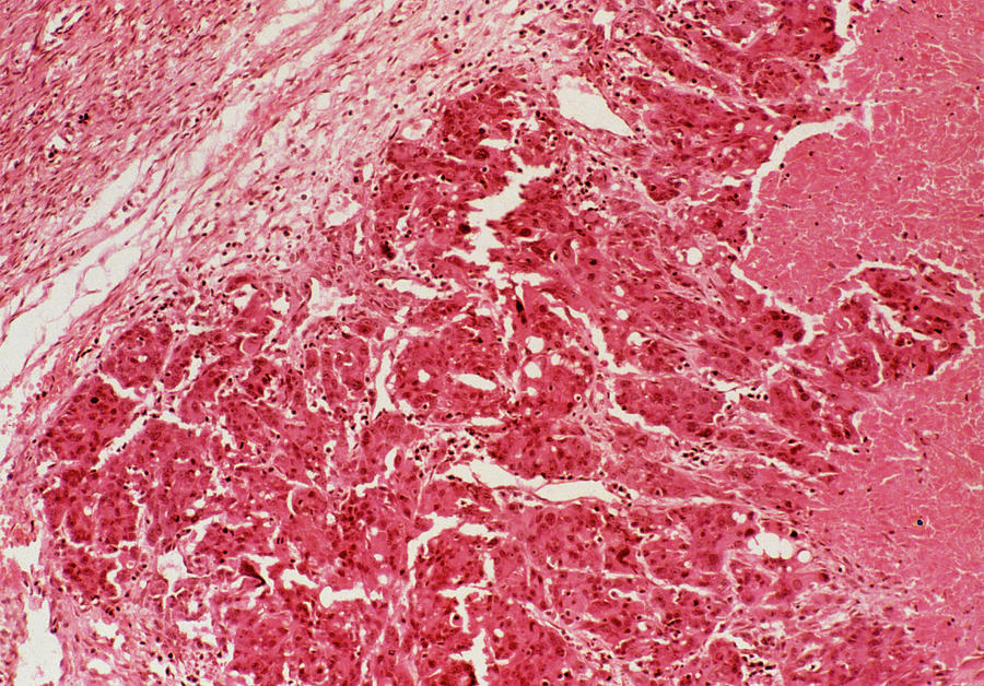Lm Of Ovarian Section With Adenocarcinoma Photograph by Science Photo Library