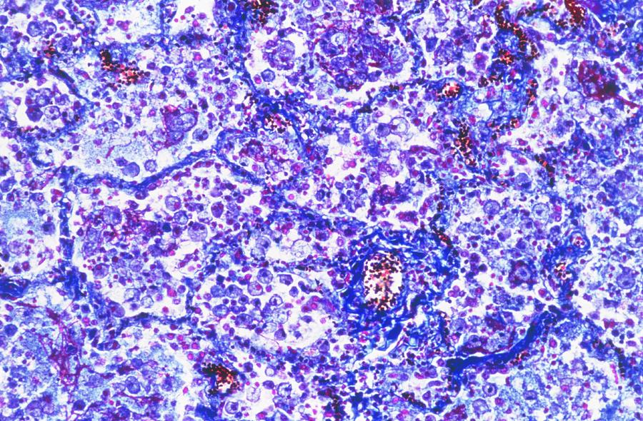 Lm Of Pneumonia In Lung by Astrid & Hanns-frieder Michler/science Photo ...