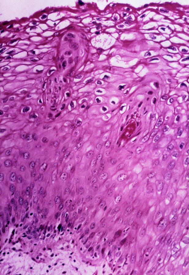 Lm Of Section Of Cervix Revealing Hpv Infection Photograph by Science Photo Library