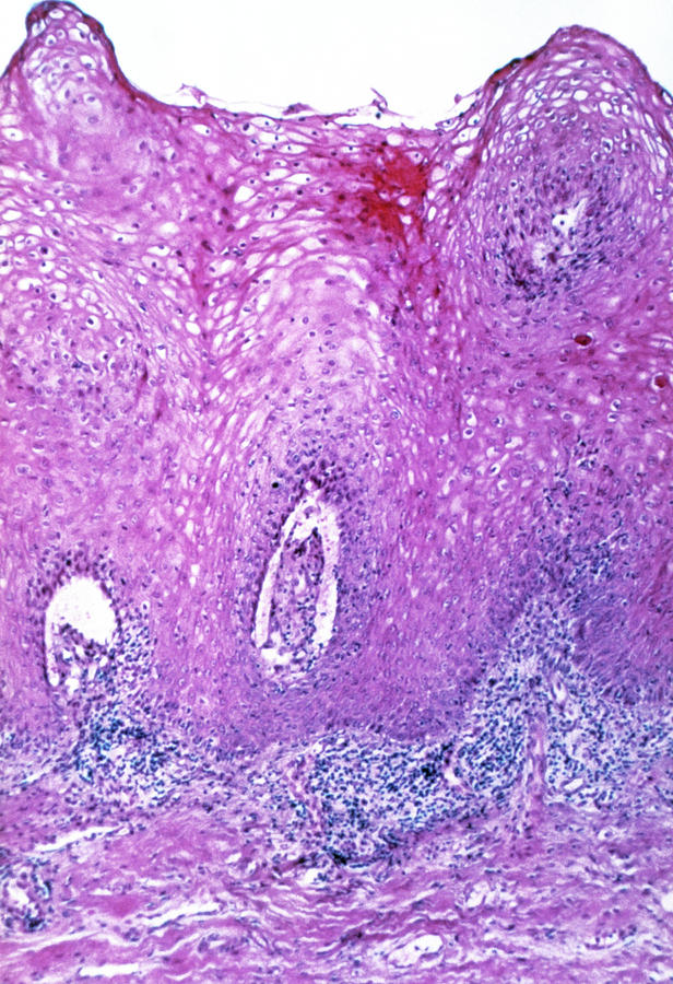 Lm Of Section Of Through A Genital Wart Photograph By Science Photo Library 