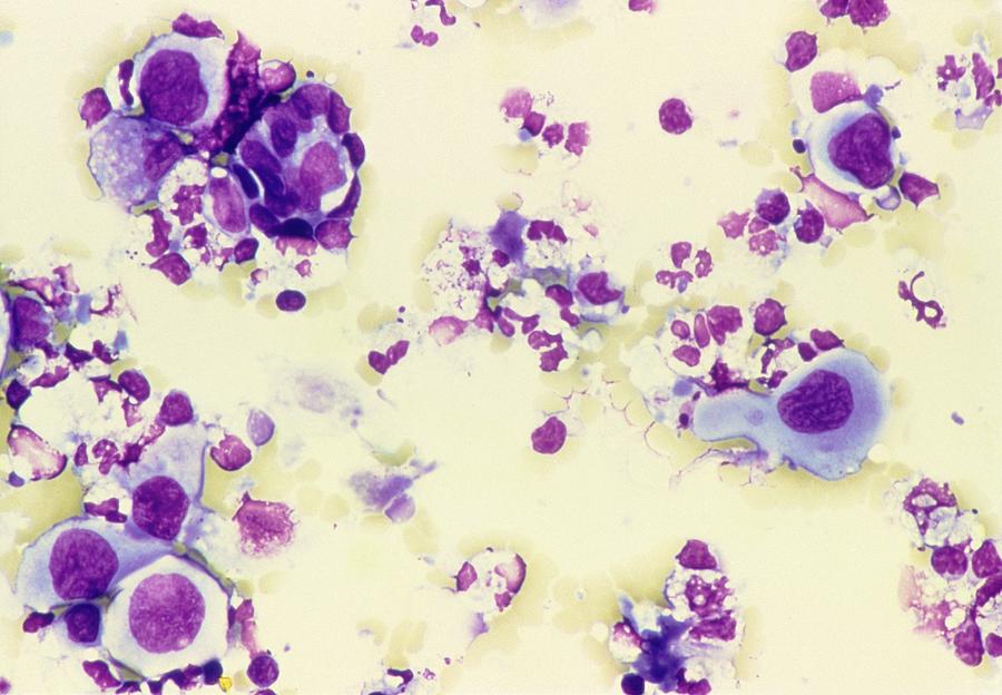 Lm Of Squamous Cancer Cells In Urine Photograph By Jonathan Ashton