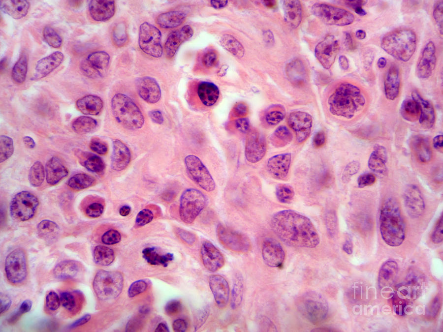 Lm Of Squamous Cell Carcinoma Photograph by Garry DeLong