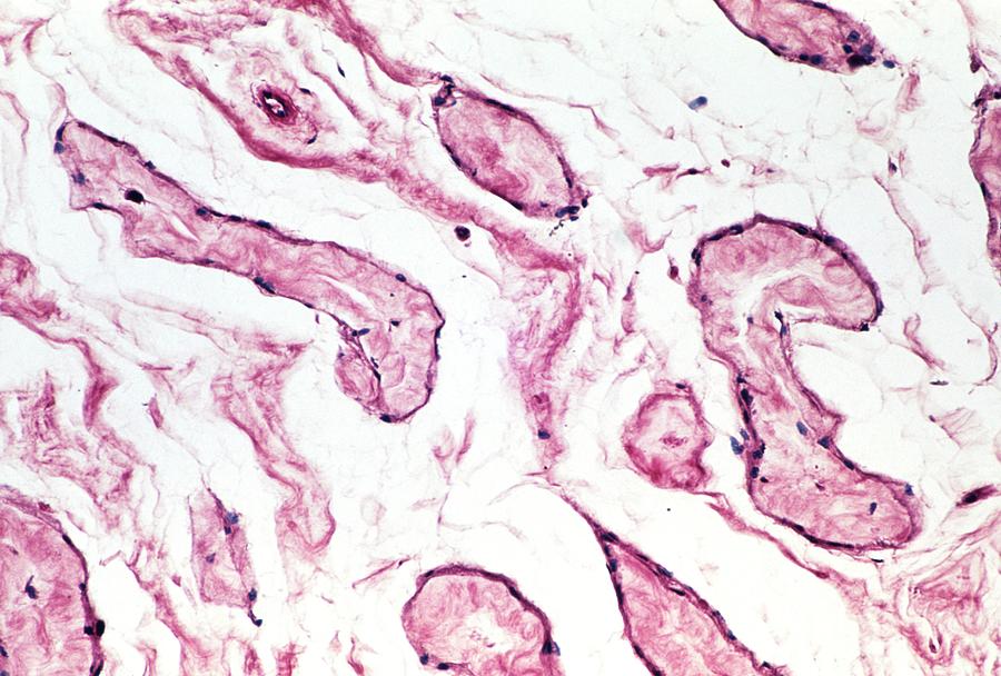 Syphilis Photograph - Lm Of Testicular Tissue Showing Tertiary Syphilis by Astrid & Hanns-frieder Michler/science Photo Library