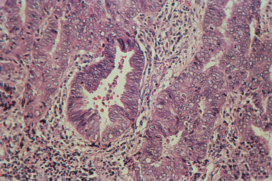 Lm Showing Human Endometrial Adenocarcinoma Photograph by Science Photo Library