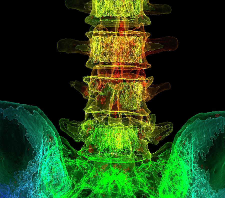 Lumbar Spine Degeneration Photograph by K H Fung/science Photo Library