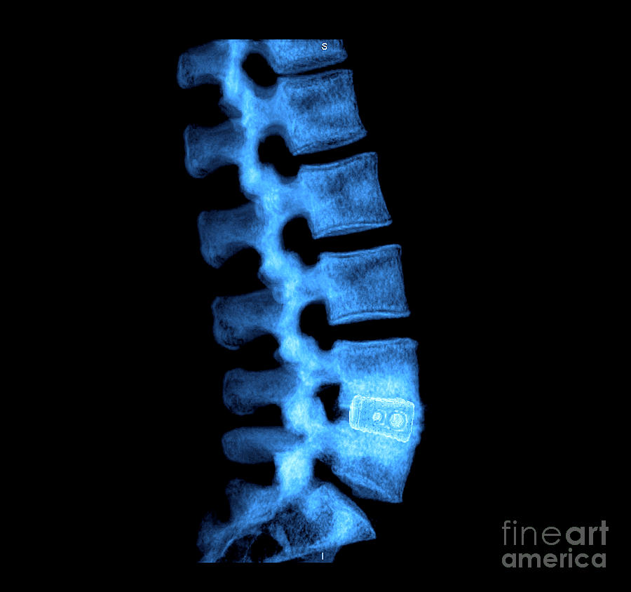 Lumbar Spine With Fusion Cages Photograph by Living Art Enterprises LLC