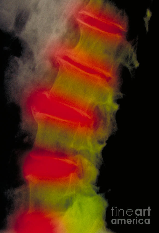 Lumbar Spine X-ray, Severe Photograph by Scott Camazine & Sue Trainor