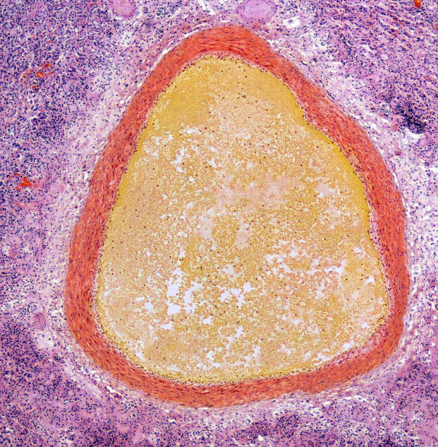Lung aneurysm, light micrograph Photograph by Steve Gschmeissner/spl
