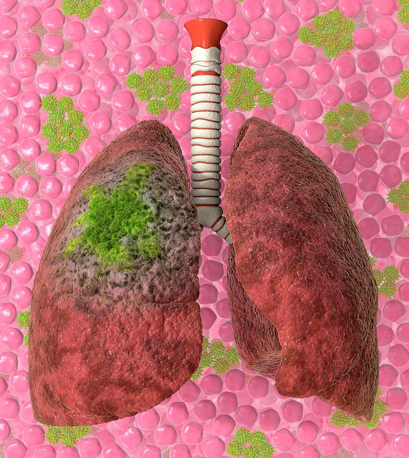 Lung Cancer Photograph by Animated Healthcare Ltd/science Photo Library