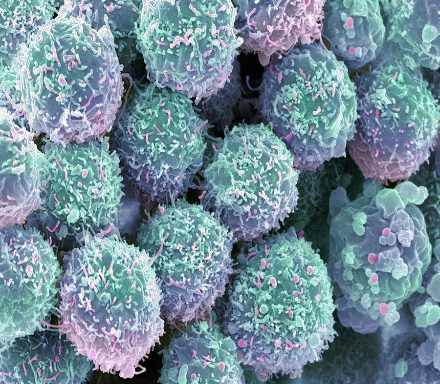 Lung Cancer Cells Photograph by Steve Gschmeissner