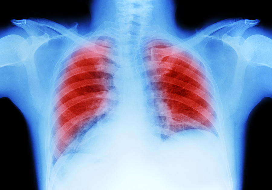 Lung cancer chest X-ray Photograph by Peter Dazeley