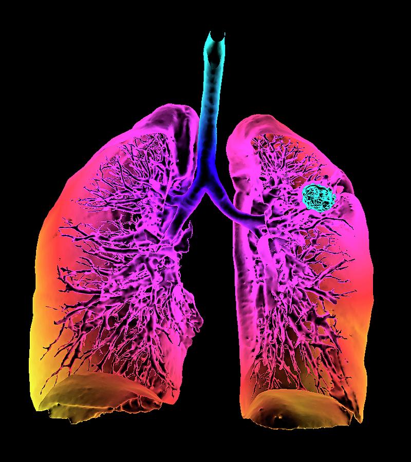 Lung Cancer Photograph by K H Fung/science Photo Library - Fine Art America