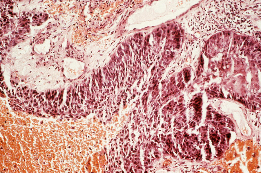 Lung Cancer, Lm Photograph by Biophoto Associates