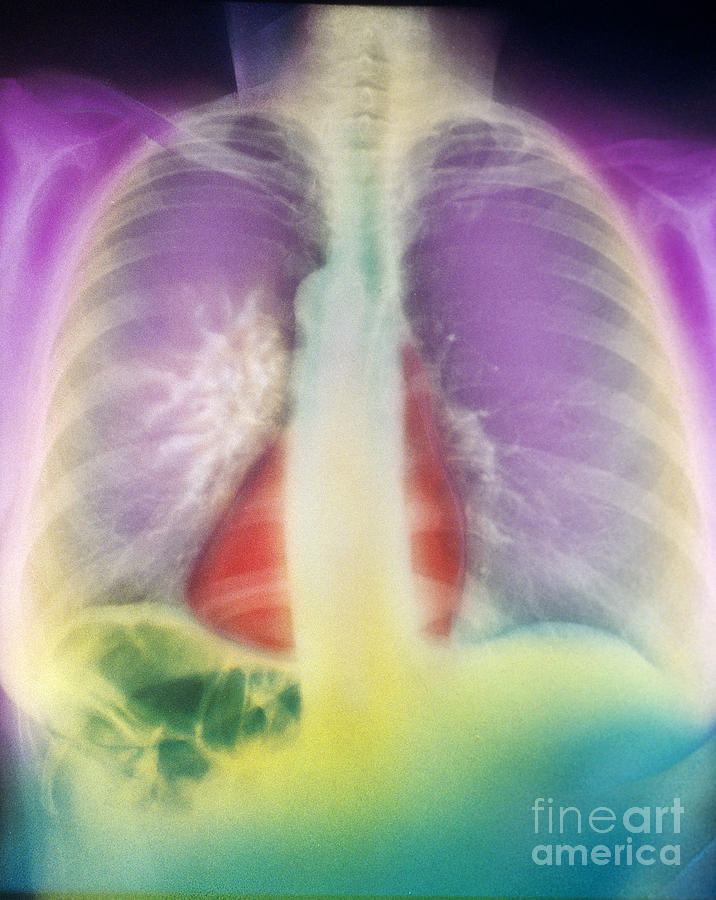 Lung Cancer, X-ray Photograph by Chris Bjornberg