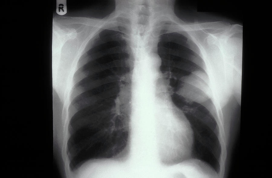 Lung Cancer X-ray Photograph by Dr M.a. Ansary/science Photo Library ...