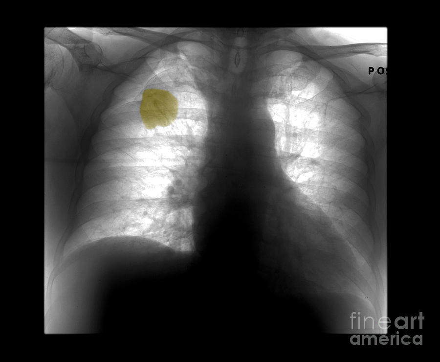 Lung Cancer, X-ray Photograph by Living Art Enterprises