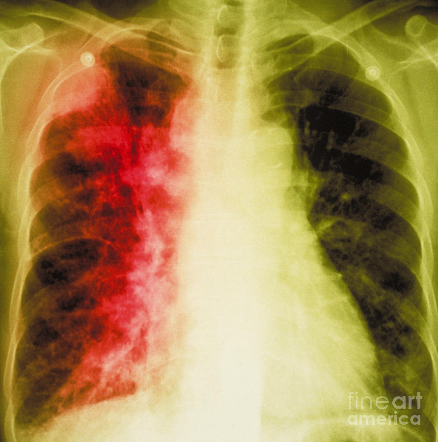 Lung Cancer X-ray Photograph by Scott Camazine