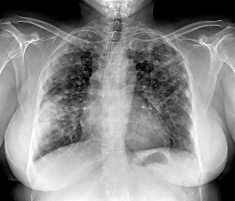 lung-disease-photograph-by-zephyr-science-photo-library-pixels