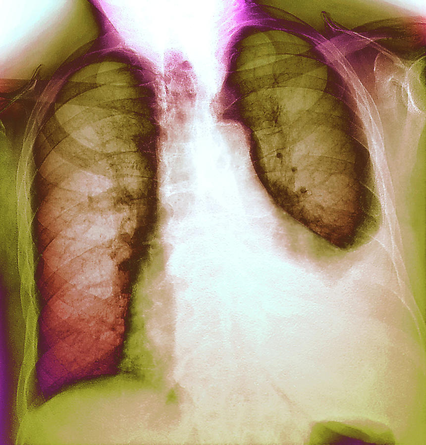 lung-infection-photograph-by-zephyr-science-photo-library-pixels