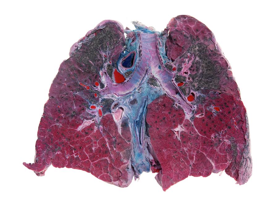 lung disease caused by silica dust