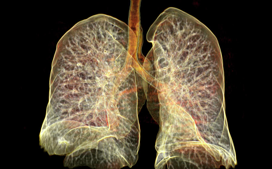 Lungs Photograph - Lungs by Antoine Rosset/science Photo Library