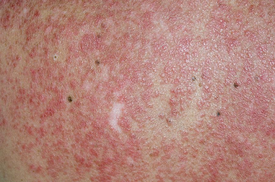 Lupus Rash On Back Triggered By Sun Photograph By Dr P Marazziscience