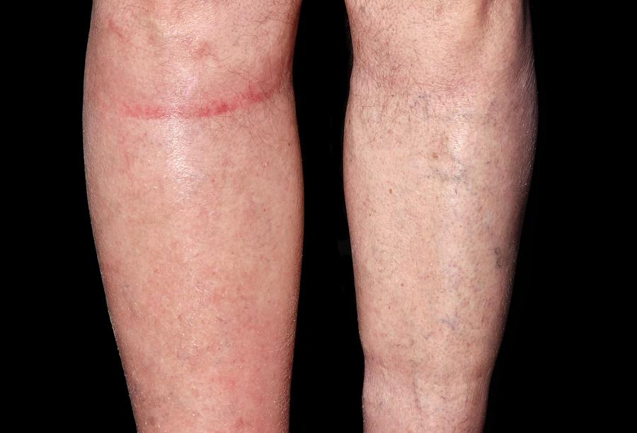 Lymphoedema Of The Right Leg Photograph By Dr P Marazziscience Photo