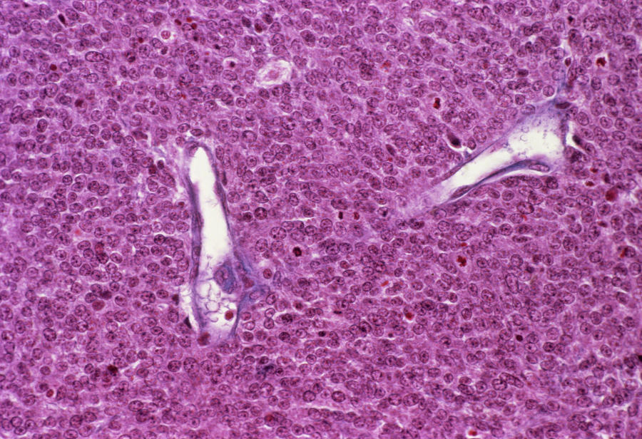 Lymphoma Brain Tumour Photograph by Cnri/science Photo Library