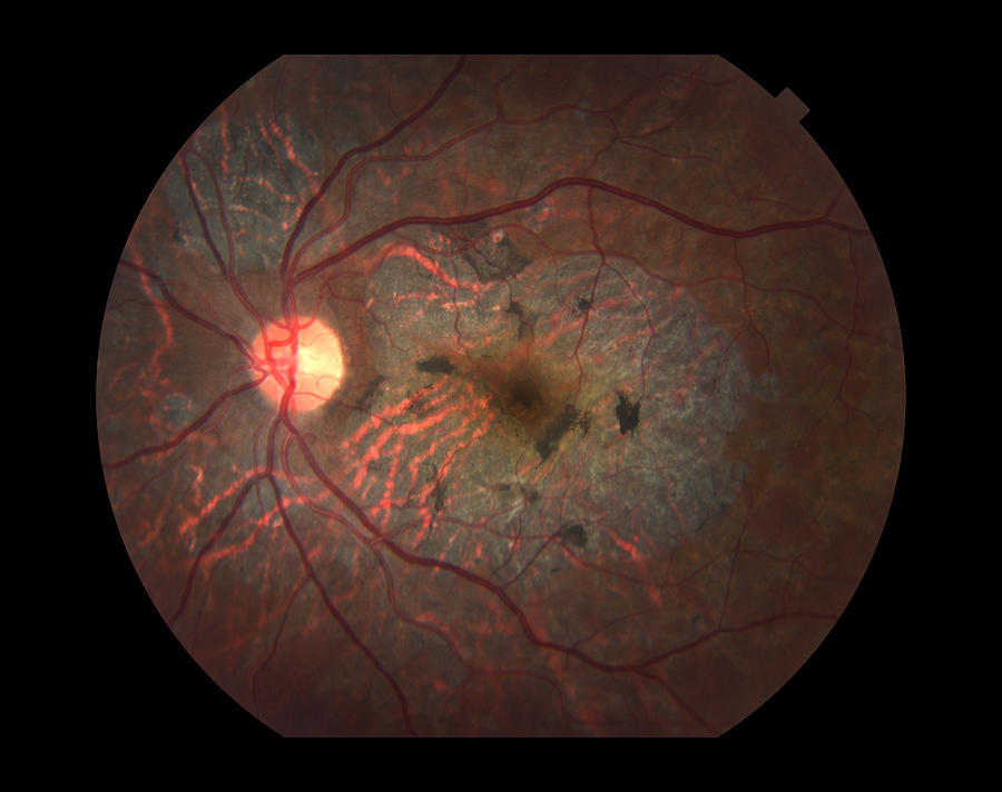 Macular Dystrophy, Ophthalmic Medicine Photograph by Paul Whitten
