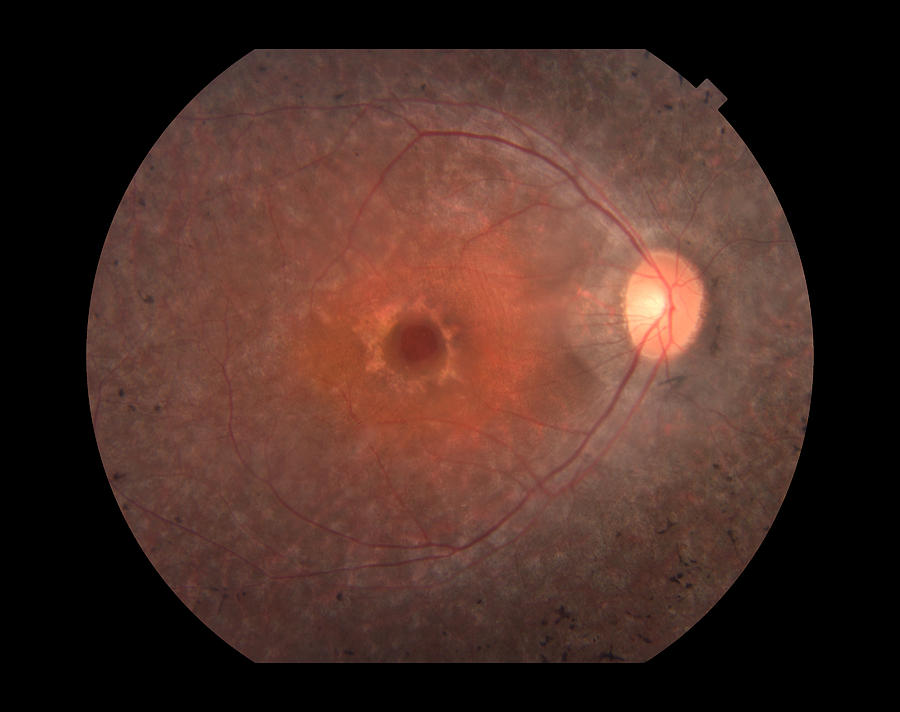 Macular Hole, Ophthalmic Medicine Photograph by Paul Whitten