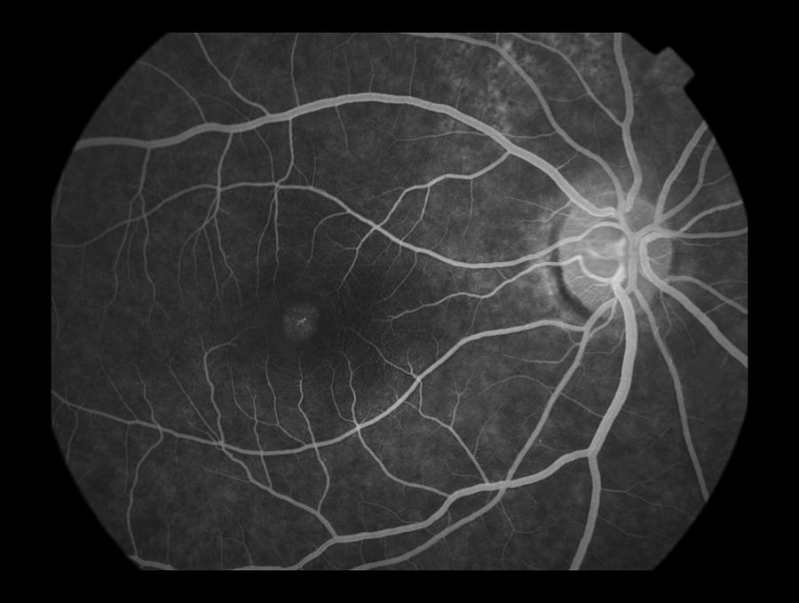 Macular Hole Photograph by Paul Whitten - Fine Art America