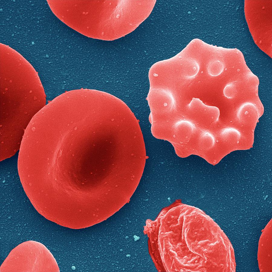 Malaria Infected Red Blood Cell Photograph by Juergen Berger/science Photo Library