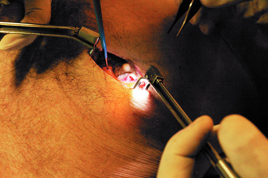 Male Breast Reduction Surgery Photograph by Mauro Fermariello/science Photo Library