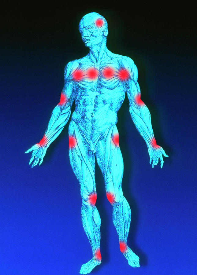 Male Figure Depicting Pain Points In Fibromyalgia ...