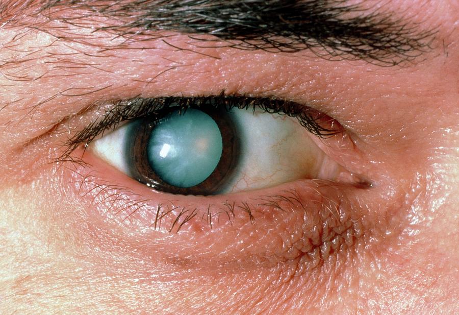 Male Patients Eye With Mature Cataract Photograph by Sue Ford/science Photo Library
