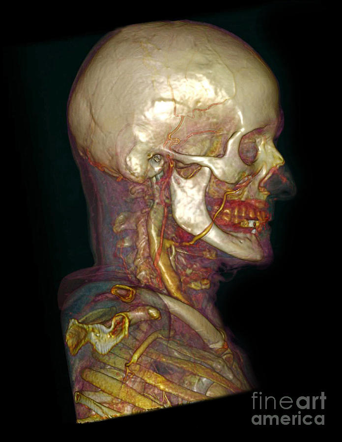 Male Skull & Arterial System Photograph by Scott Camazine